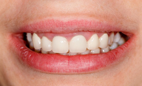 Dental Veneers