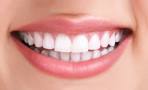 Dental Veneers